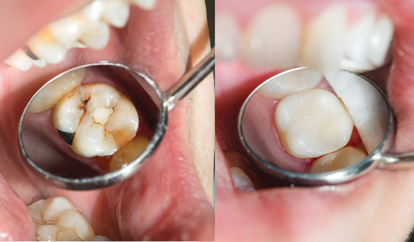 Zahnfüllungen/ Wurzelbehandlung - Zahnarztpraxis Dr. Umar, MSc l Spezialist  für Parodontologie (ÖGP)